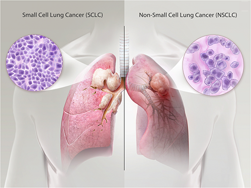 Exploring Lung Pathologies With Physiology & Pathology